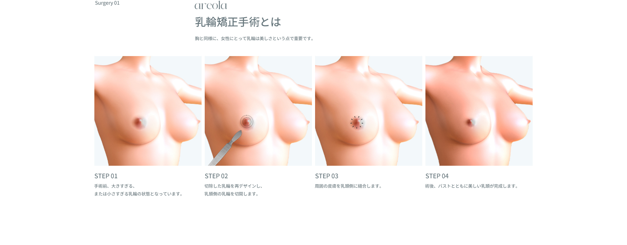 乳輪/乳頭矯正