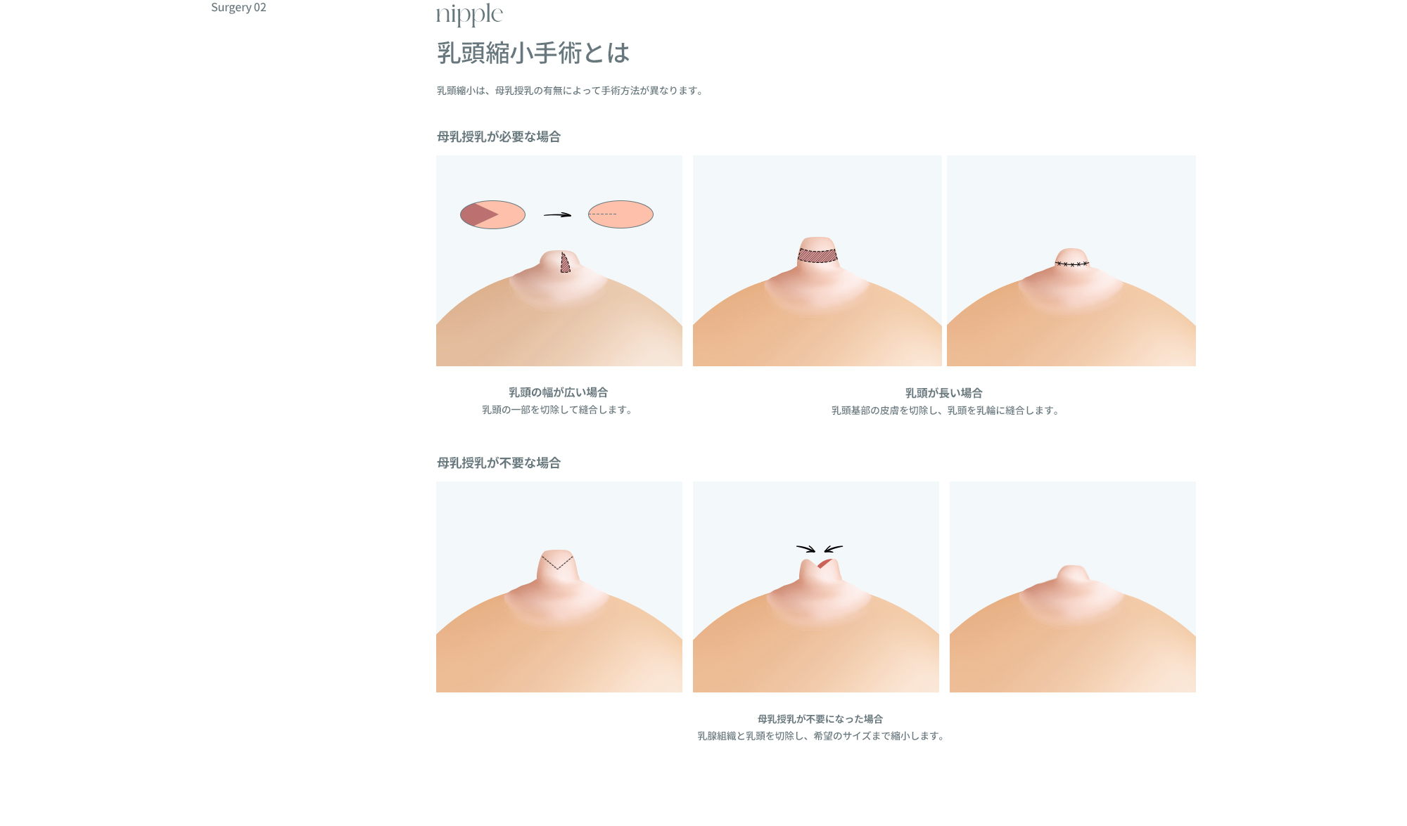 乳輪/乳頭矯正