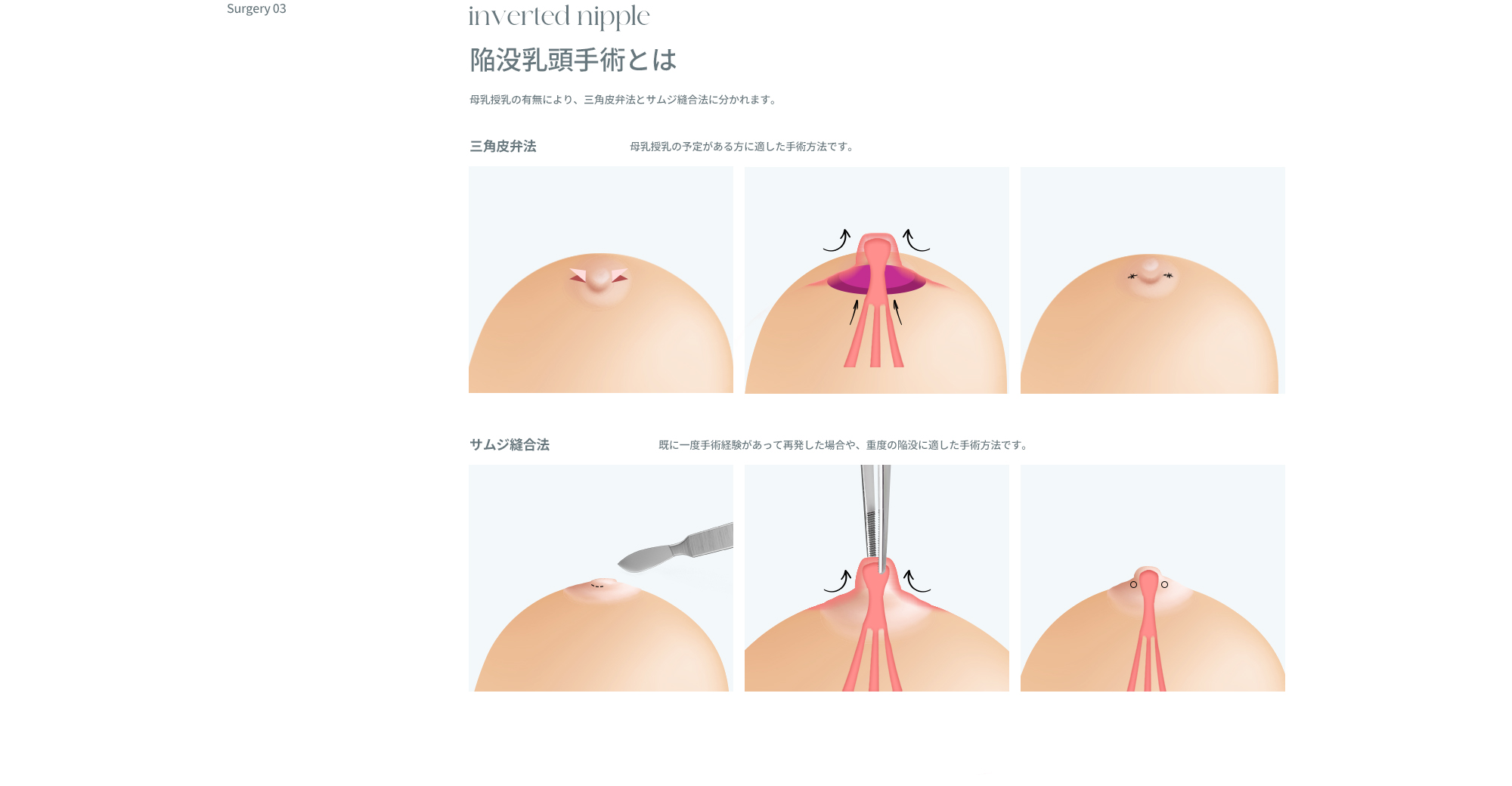 乳輪/乳頭矯正
